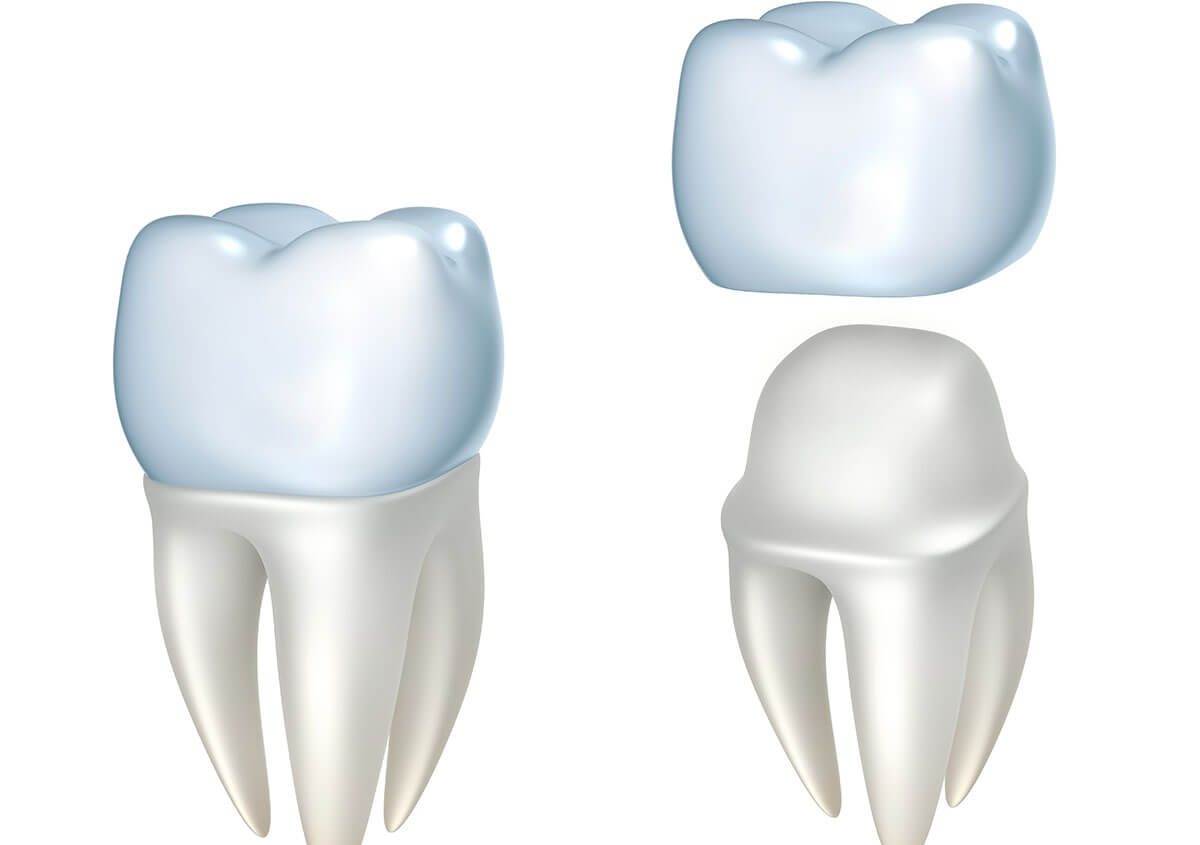 Dental Crowns for Teeth in Sunnyvale CA Area